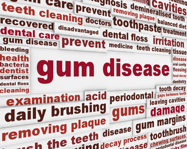 Gum Recession Risk Factors