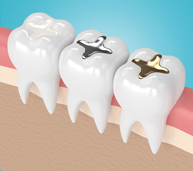 Can Dental Fillings Treat Tooth Decay? - Arc Advanced Dentistry