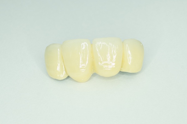 The Longevity Of Dental Bridges: What You Should Know