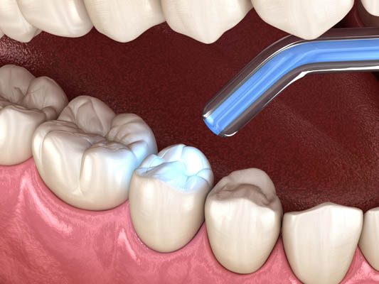 Dental Fillings Procedure