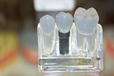 Three Signs That You Should Consider Implant Dentistry