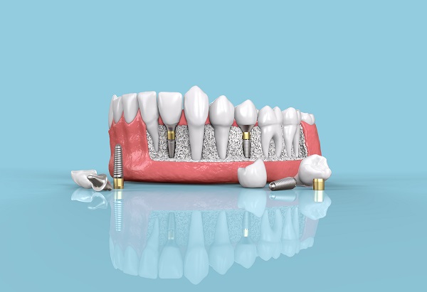 Dental Implants Long Beach, NY