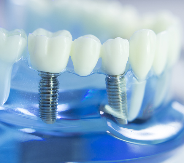 Long Beach Dental Implants