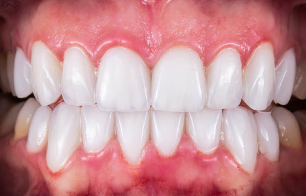 Choose Dental Veneers For An Even And Symmetrical Smile