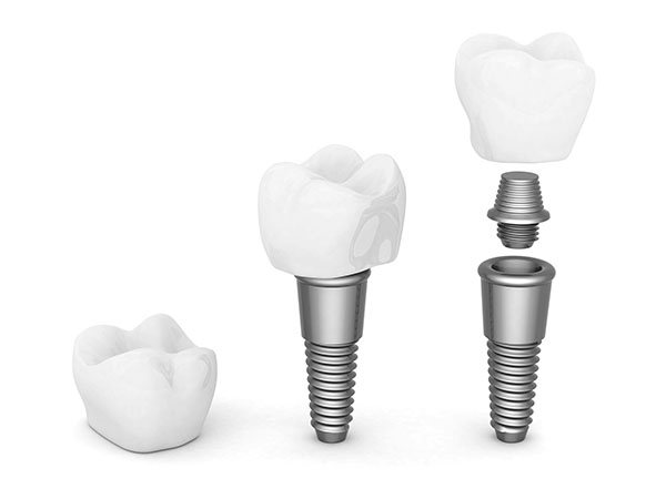 An Implant Restoration Treatment In Long Beach Can Improve Your Smile And The Function Of Your Teeth
