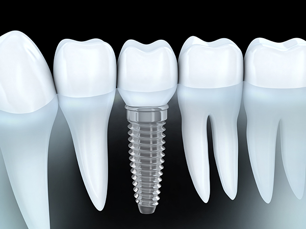An Implant Restoration Can Restore Your Tooth After An Accident