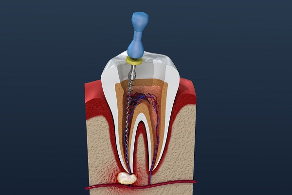 Why You Shouldn&#    ;t Be Scared Of Getting A Root Canal